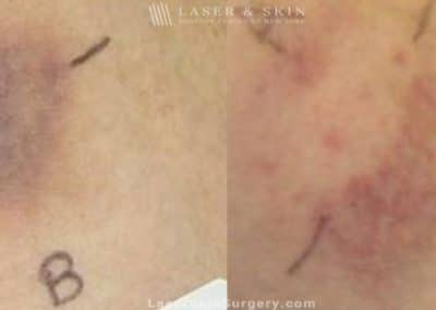 Laser Treatment for Bruising