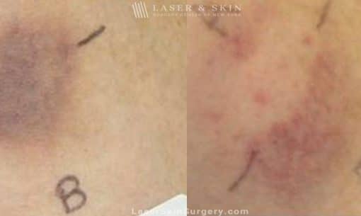 Laser Treatment for Bruising