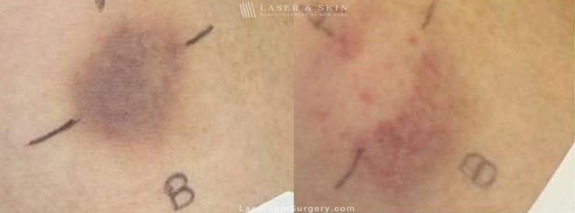 before and after image of a laser treatment for bruising on the cheek area