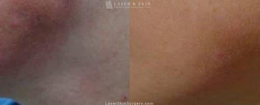 Laser Treatment for Bruising on the Chin