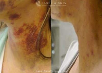 Laser Treatment for Bruising on the Neck