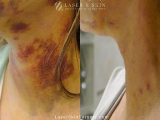 Laser Treatment for Bruising on the Neck