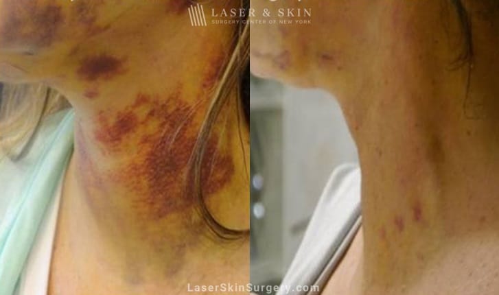 before and after image of a laser treatment for bruising on a woman's neck