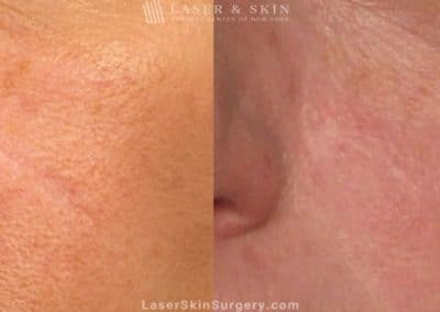 Laser Treatment to Remove a Facial Scar