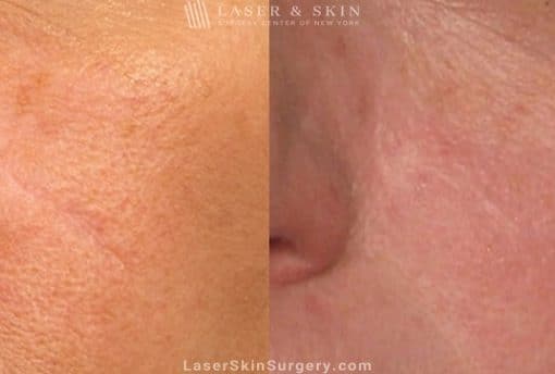 Laser Treatment to Remove a Facial Scar