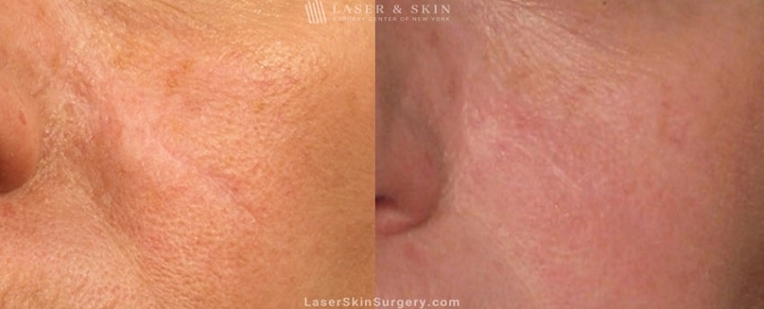 before and after image after a laser treatment for a scar on the side of a woman's face