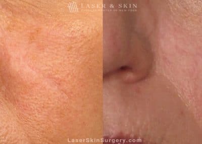 Laser Treatment to Remove a Facial Scar