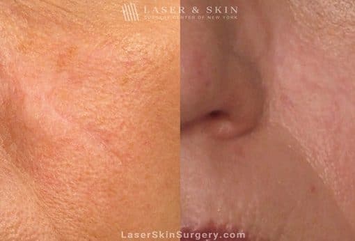 Laser Treatment to Remove a Facial Scar