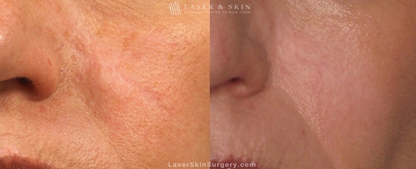 before and after image after a laser treatment for a scar on the side of a woman's face