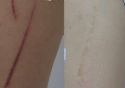 Laser treatment to remove red scars from the leg