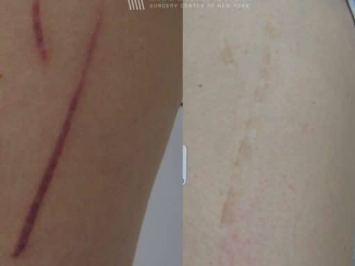 Laser treatment to remove red scars from the leg