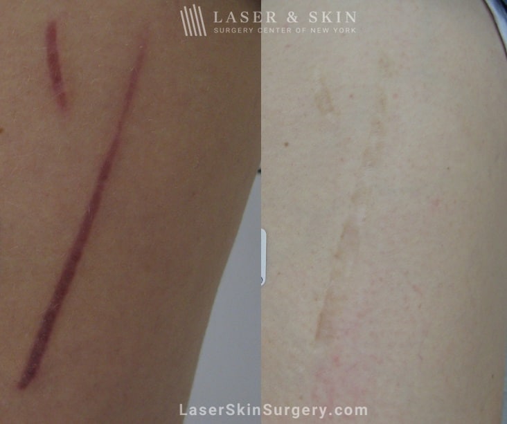 before and after image after a laser treatment for a scar on the leg