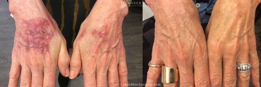 before and after image after a laser treatment for a scars on a woman's hand