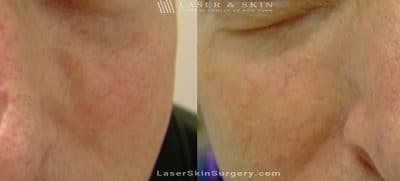 Laser Treatment to Remove a Scar on the Nose