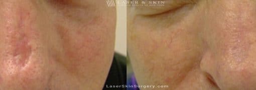 Laser Treatment to Remove a Scar on the Nose