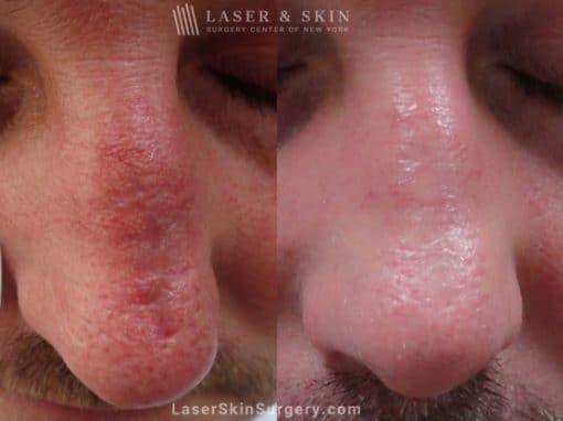 Laser Treatment to Remove a Scar After Mohs Surgery