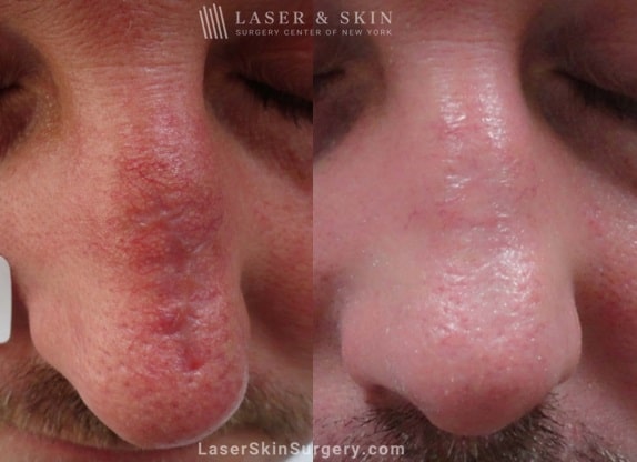 before and after image after a laser treatment for a scar on the top of a man's nose