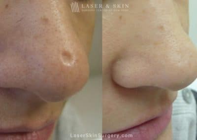 Laser Treatment to Remove a Scar on The Nose