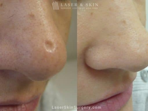 Laser Treatment to Remove a Scar on The Nose