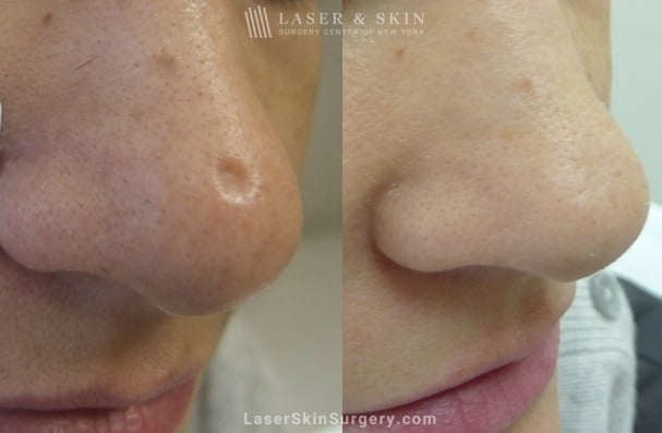 before and after image after a laser treatment for a scar on the tip of the nose