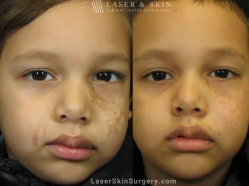 Laser Treatment to Remove a Scar on a Little Boy’s Face