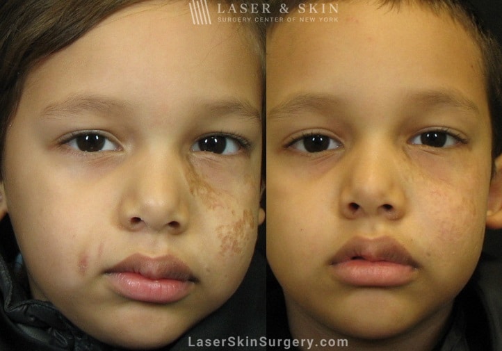 before and after image after a laser treatment for a scar on a little boy's face