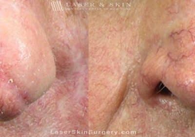 Laser Treatment for the Removal of a Facial Scar