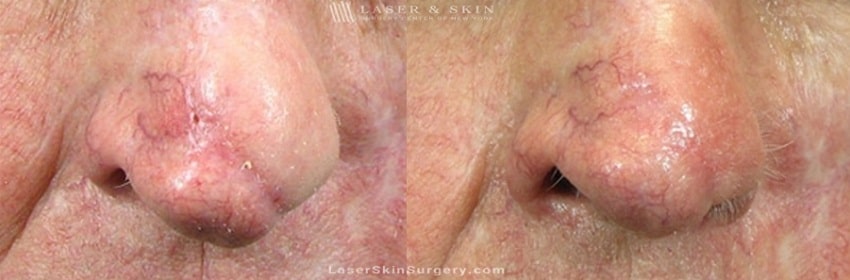 before and after image of a laser treatment for a scar on on the tip of a man's nose