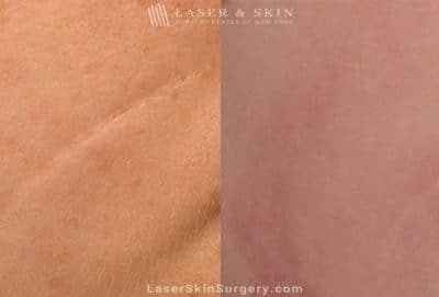Laser Treatment for the Removal of a Facial Scar