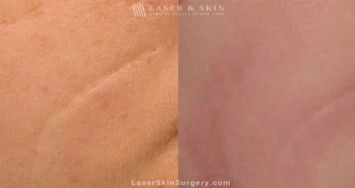 Laser Treatment for the Removal of a Facial Scar