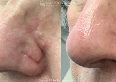 Laser treatment to remove scar from patient’s nose