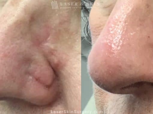 Laser treatment to remove scar from patient’s nose