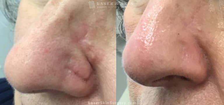 Laser treatment to remove scar from patient’s nose