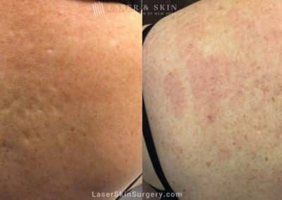 Laser Treatment for Acne Scarring on the Back