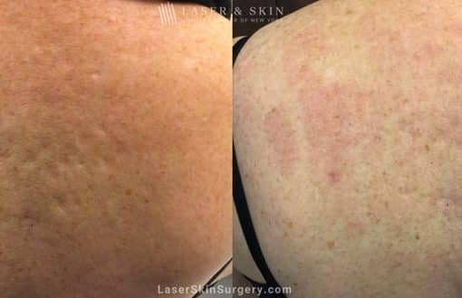 Laser Treatment for Acne Scarring on the Back