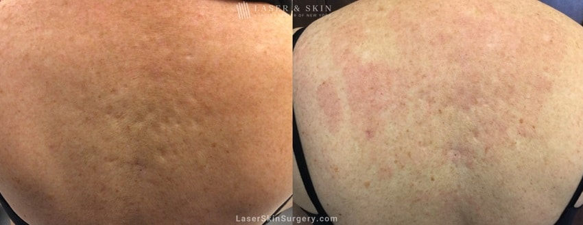 before and after image of a laser treatment to treat scars related to back acne