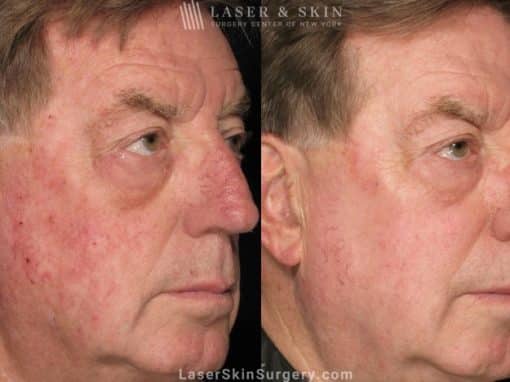 Fraxel Laser Treatment for Sun Damage