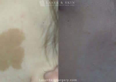 Laser Treatment for Café Au Lait – Pigmented Birthmarks