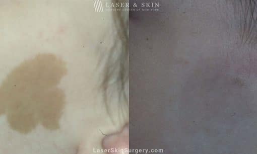 Laser Treatment for Café Au Lait – Pigmented Birthmarks