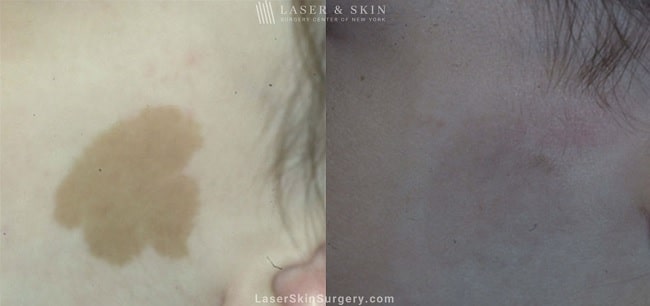 before and after image of a laser treatment for cafe au lait on the cheek