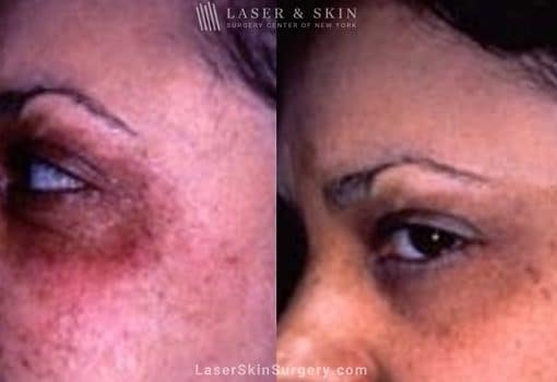 Laser Treatment for Café au Lait – Pigmented Birthmarks