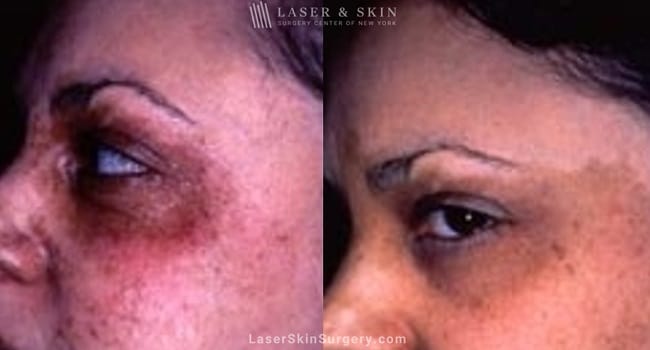 before and after image of a laser treatment for cafe au lait around the eye on skin of color