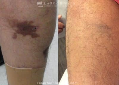 Laser used to remove Café au Lait birthmark