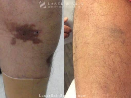 Laser used to remove Café au Lait birthmark