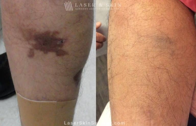 Laser used to remove Café au Lait birthmark