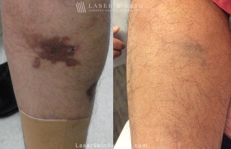 before and after image of a laser treatment to treat a hyper pigmentation on the leg