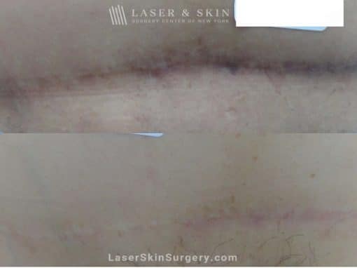 Laser Treatment for a Pigmented Scar on the Stomach