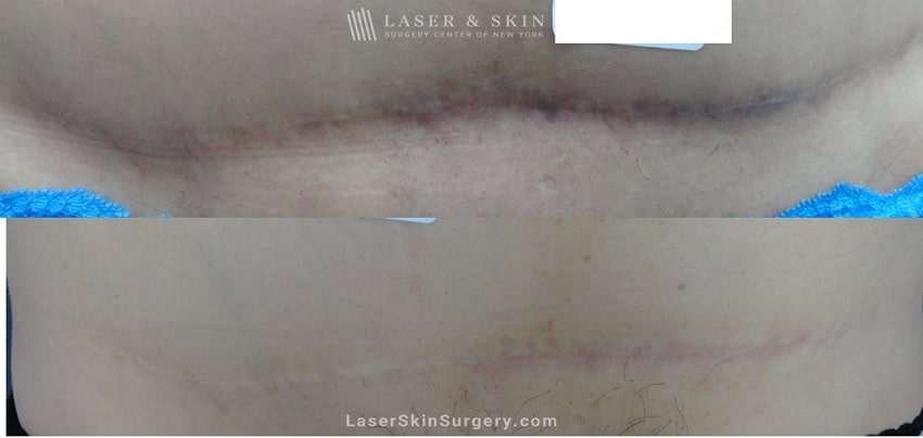 before and after image of a laser treatment to treat a pigmented scar on the stomach