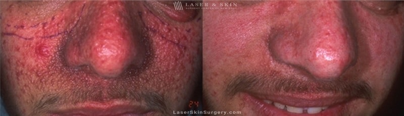 before and after image of a laser treatment for Tuberous Sclerosis angiofibromas on a man's face