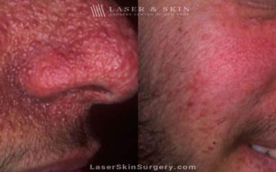 Laser Treatment for Tuberous Sclerosis (Angiofibromas)